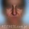 Korekcja nosa (Operacja nosa)