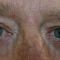 Operácia očných viečok (Blepharoplastika)