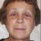 Facelift, SMAS facelifting