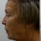 Facelift, SMAS facelifting