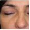 Operácia očných viečok (Blepharoplastika)