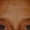 Chemisches Peeling