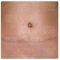 Abdominoplastika (Operácia brucha)