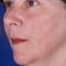 Fractional Laser Resurfacing