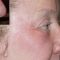 Fractional Laser Resurfacing