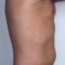 Liposonix