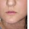 Lip augmentation - cheiloplasty