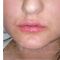 Lip augmentation - cheiloplasty