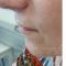 Lip augmentation - cheiloplasty