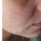 Chemisches Peeling