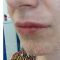 Lippenvergrößerung (Lipofilling, Fettinjektion)