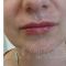 Lippenvergrößerung (Lipofilling, Fettinjektion)