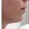 Liquid lifting (Liquid facelift)