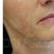 Liquid lifting (Liquid facelift)