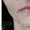 Liquid lifting (Liquid facelift)