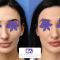 Rinoplastie