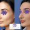 Rinoplastie