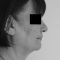 Lifting du visage