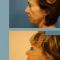 Filler antirughe a base di acido ialuronico