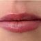 Lippenvergrößerung mit Hyaluronsäure