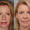 Liquid facelift