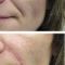 Facelift, SMAS facelifting