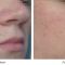 Laser acne treatment
