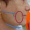 Facelift, SMAS facelifting