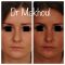Rhinoplastie