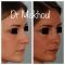 Rhinoplastie
