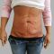 Abdominoplastika (Operace břicha)