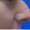 Plastika nosu (Rhinoplastika)