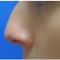 Plastika nosu (Rhinoplastika)