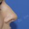 Rinoplastie