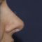 Rinoplastie
