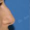 Rinoplastie