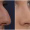 Rhinoplasty (Nose Job)