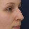 Rhinoplasty (Nose Job)