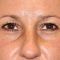 Korekcja powiek (Blepharoplastyka)