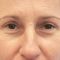 Korekcja powiek (Blepharoplastyka)