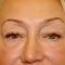 Korekcja powiek (Blepharoplastyka)