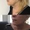 Lifting du visage