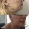 Lifting du visage