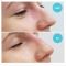 Operácia nosa (Rhinoplastika)