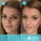 Operácia nosa (Rhinoplastika)