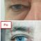 Operace očních víček (Blefaroplastika)