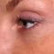 Botulinum toxin - Wrinkle Removal