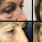 Blépharoplastie