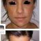 Lipofilling ou autogreffe de tissu graisseux