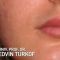 Lip augmentation - cheiloplasty